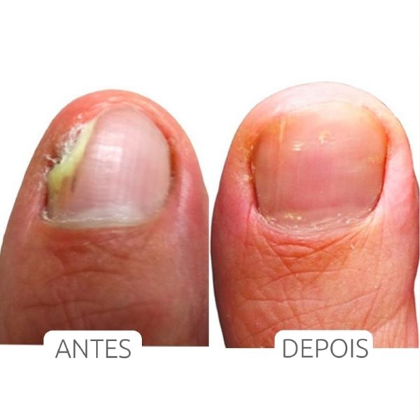 Micozione - Fortalecedor e Reparador de unhas - Biozenthi 10ml - Image 3